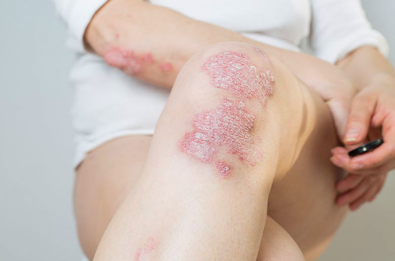 Psoriasis