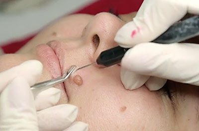Mole removal